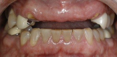 Before: IMPLANTS