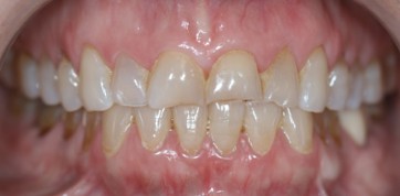 Before: VENEERS