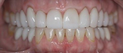 After: VENEERS