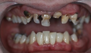 COMPOSITE RESTORATIONS