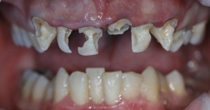 COMPOSITE RESTORATIONS