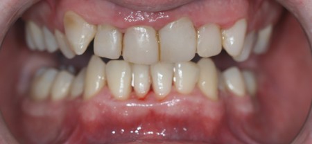 COMPOSITE RESTORATIONS