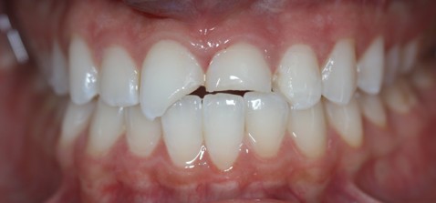 NON PERMANENT RESIN VENEERS
