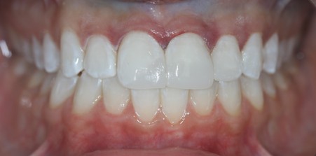 NON PERMANENT RESIN VENEERS